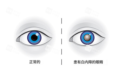 正常眼睛和患有白内障示意图