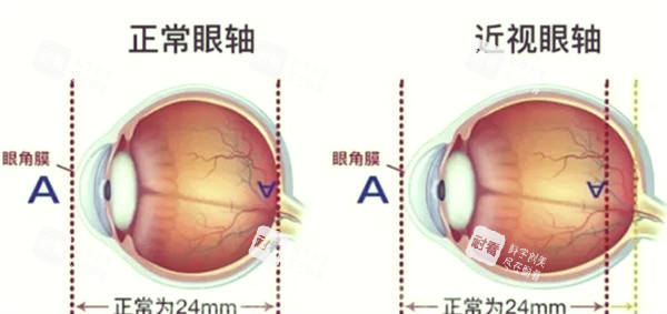 近视眼前后对比‘ 近视眼前后对比‘