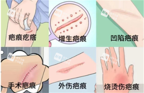 疤痕的不同类型 疤痕的不同类型