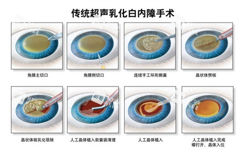 超声乳化白内障手术 超声乳化白内障手术