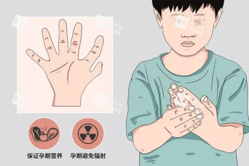 先天性多指症示意图