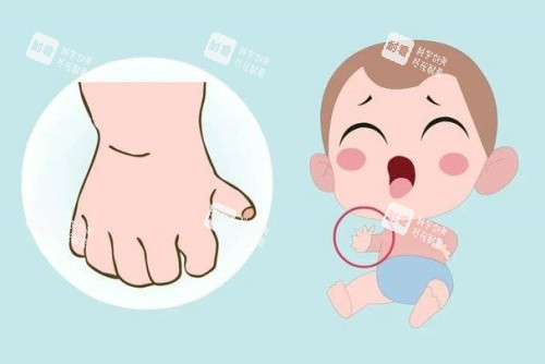儿童先天性多指症示意图