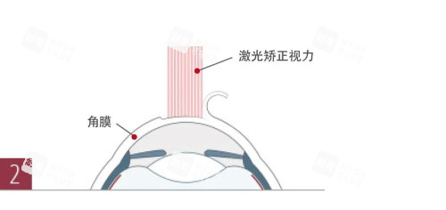 激光矫正手术示意图 激光矫正手术示意图