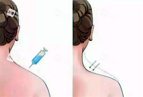 瘦身针 瘦身针