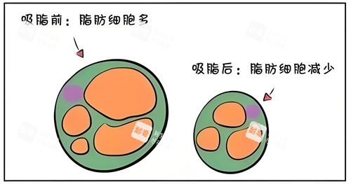 吸脂前后脂肪细胞对比动画图 吸脂前后脂肪细胞对比动画图