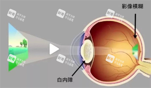 白内障成像 白内障成像