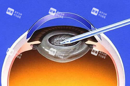 白内障手术卡通图 白内障手术卡通图