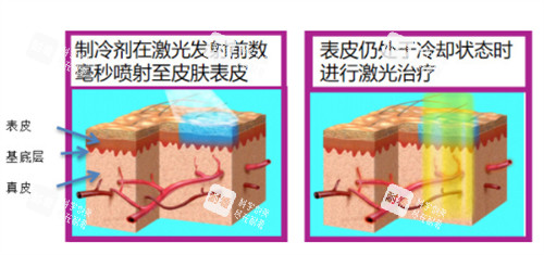 595染料激光原理 595染料激光原理
