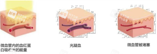 595染料激光治疗过程图解 595染料激光治疗过程图解