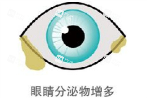 眼睛分泌物增多示意图 眼睛分泌物增多示意图