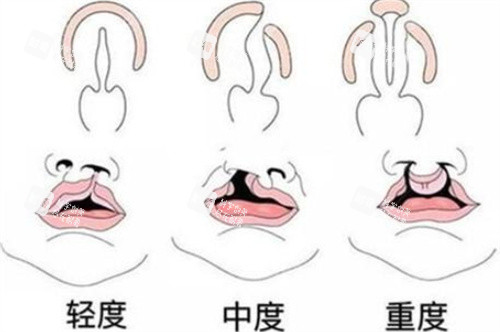 唇腭裂按不同程度划分 唇腭裂按不同程度划分
