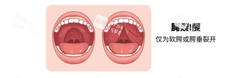 一度唇腭裂 一度唇腭裂