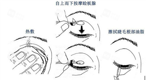 睑板腺按摩