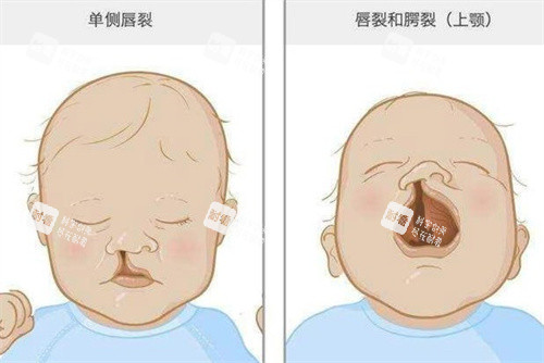 兔唇单侧唇裂