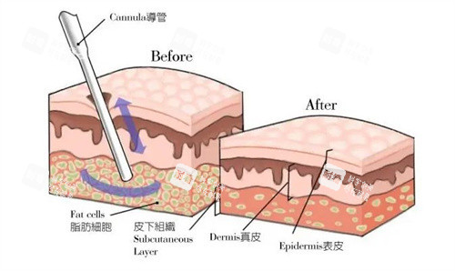 吸脂手术 吸脂手术