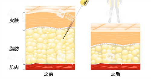 吸脂手术前后 吸脂手术前后