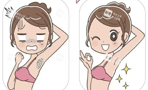激光脱腋毛