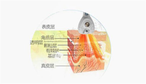 溶脂刀仪器可以深入到的层次图解 溶脂刀仪器可以深入到的层次图解