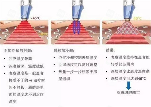 溶脂刀仪器施术过程图解 溶脂刀仪器施术过程图解