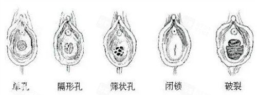 不同形状的处女膜