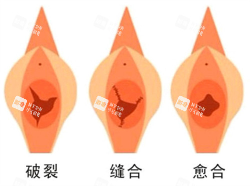 处女膜修复手术前后对比图