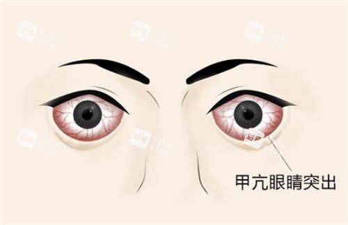 甲亢突眼的样子图片 甲亢突眼的样子图片