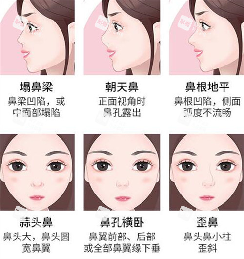 哪些鼻子需要做修复手术 哪些鼻子需要做修复手术