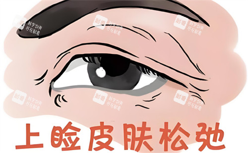 中年眼上睑皮肤松弛