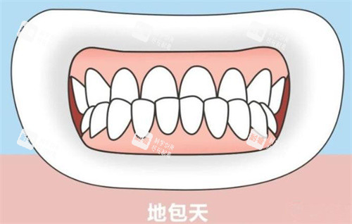 地包天卡通示意图