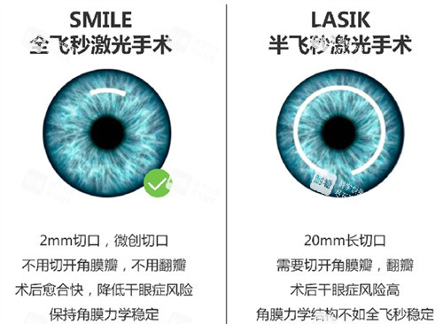 全飞秒与半飞秒手术对比图 全飞秒与半飞秒手术对比图