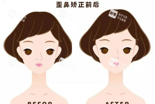 假体鼻子歪斜矫正前后示意图 假体鼻子歪斜矫正前后示意图