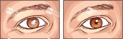 白内障眼睛区别 白内障眼睛区别