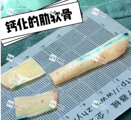 钙化的肋软骨
