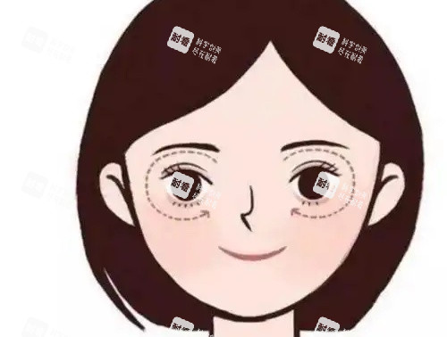 眼角下垂示意图 眼角下垂示意图