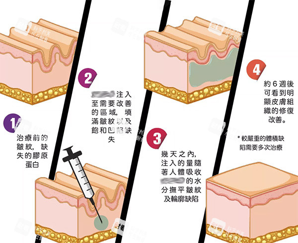左旋乳酸PLLA清秀针注射照片