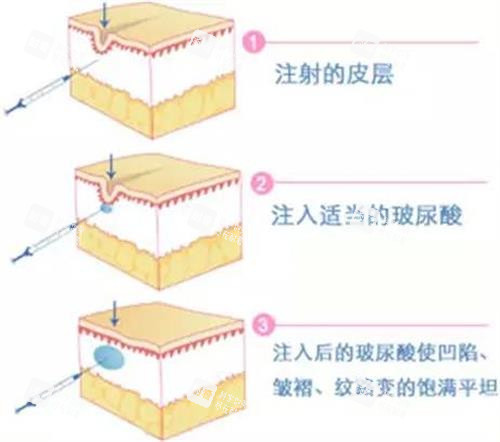 玻尿酸注射示意图 玻尿酸注射示意图