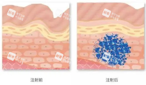 玻尿酸注射前后示意图 玻尿酸注射前后示意图