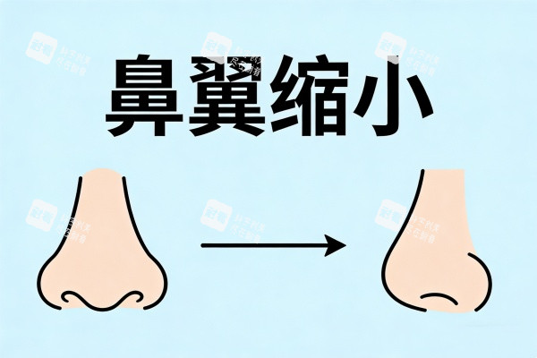 鼻翼缩小整形图片一览 鼻翼缩小整形图片一览
