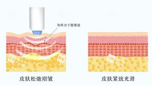 紧致肌肤效果对比 紧致肌肤效果对比