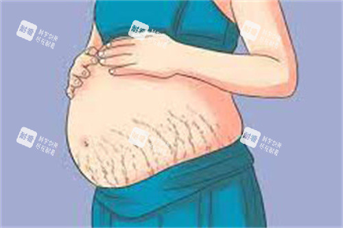 腹部妊娠纹 腹部妊娠纹