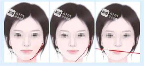 面部不对称的类型