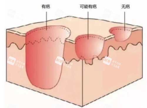 有疤无疤立体图片 有疤无疤立体图片