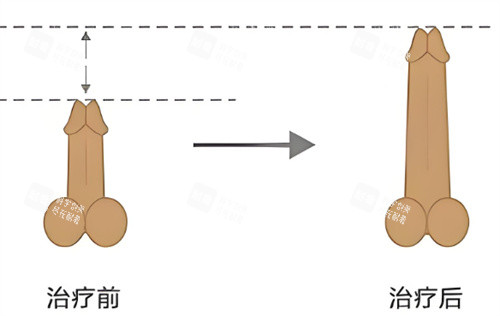 男生增大增粗示意图.jpg