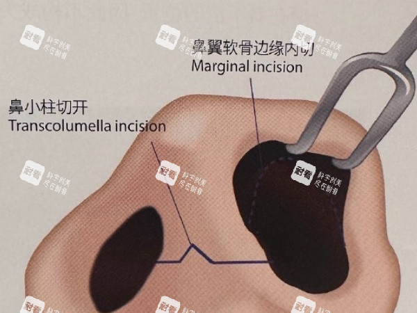 鼻翼软骨缝合切开素材