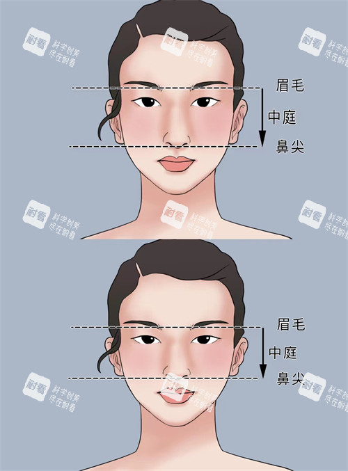 正常鼻子和过长鼻子矫正对比
