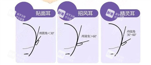 贴面耳招风耳精灵耳区别.jpg
