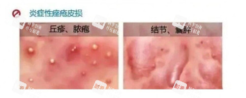 炎症性痤疮照片