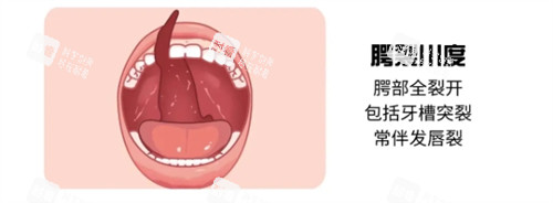三度唇腭裂 三度唇腭裂