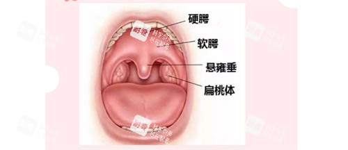 唇腭裂示意图 唇腭裂示意图