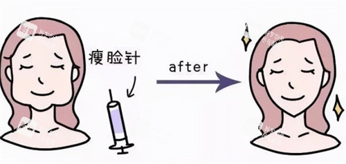 瘦脸注射前后卡通 瘦脸注射前后卡通